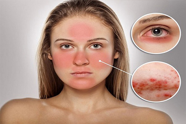 Triệu chứng da mặt bị dị ứng sần sùi và cách khắc phục