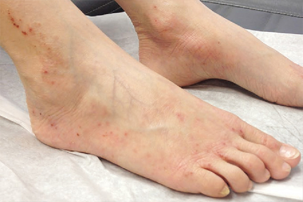 Ngứa mẩn đỏ ở chân nguy hiểm như thế nào?
