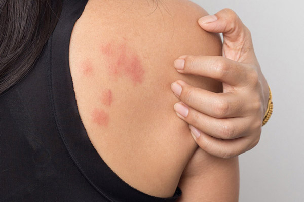 Nổi mẩn ngứa ở da là dấu hiệu bệnh gì?